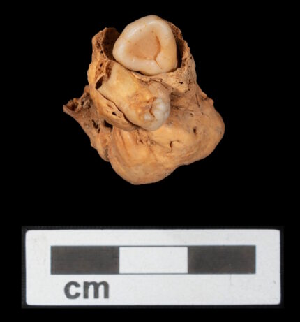 Oldest archaeological teratoma found in New Kingdom burial